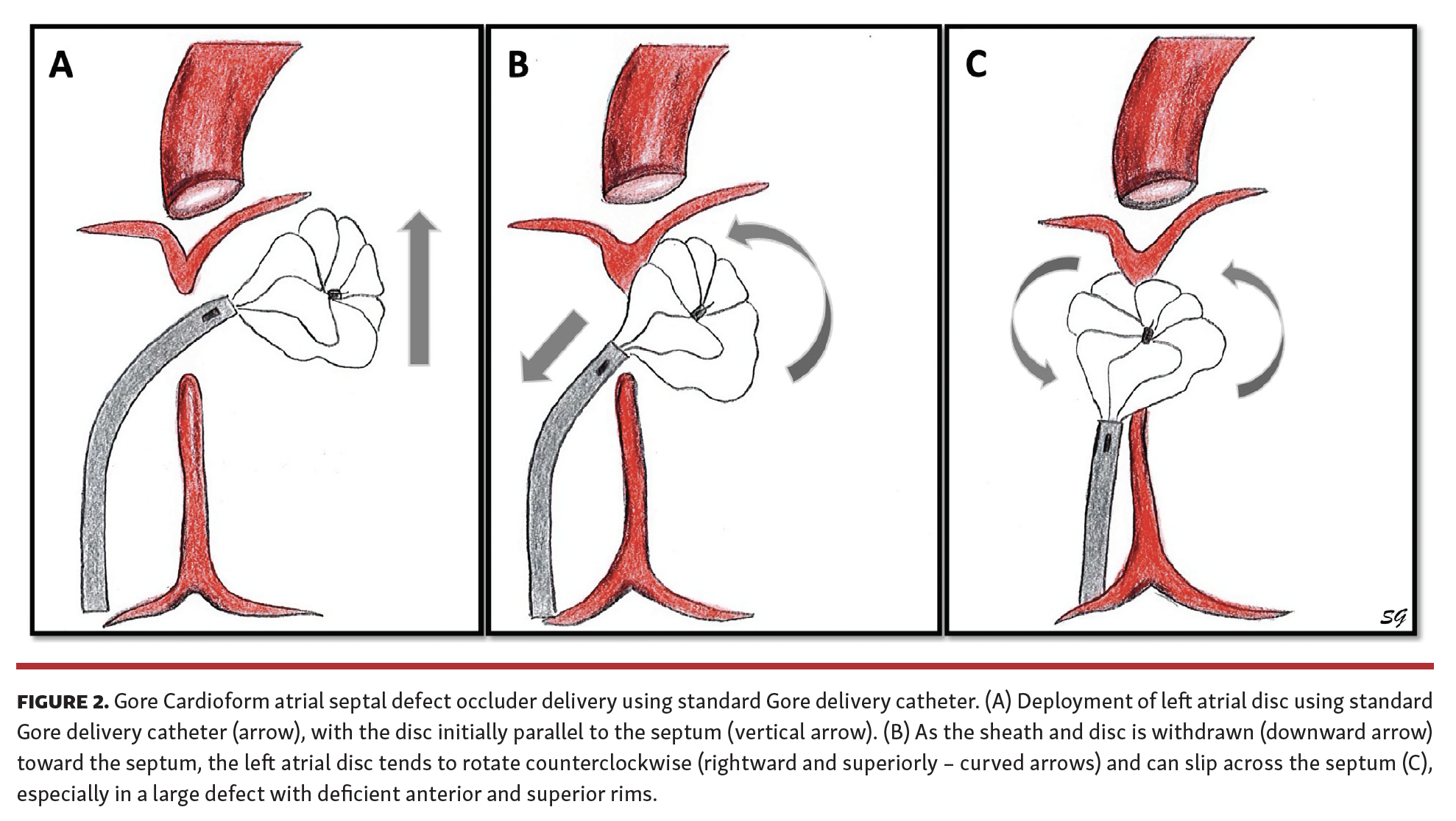 MullinsSheath Facilitated Delivery of Gore Cardioform ASD Occluder